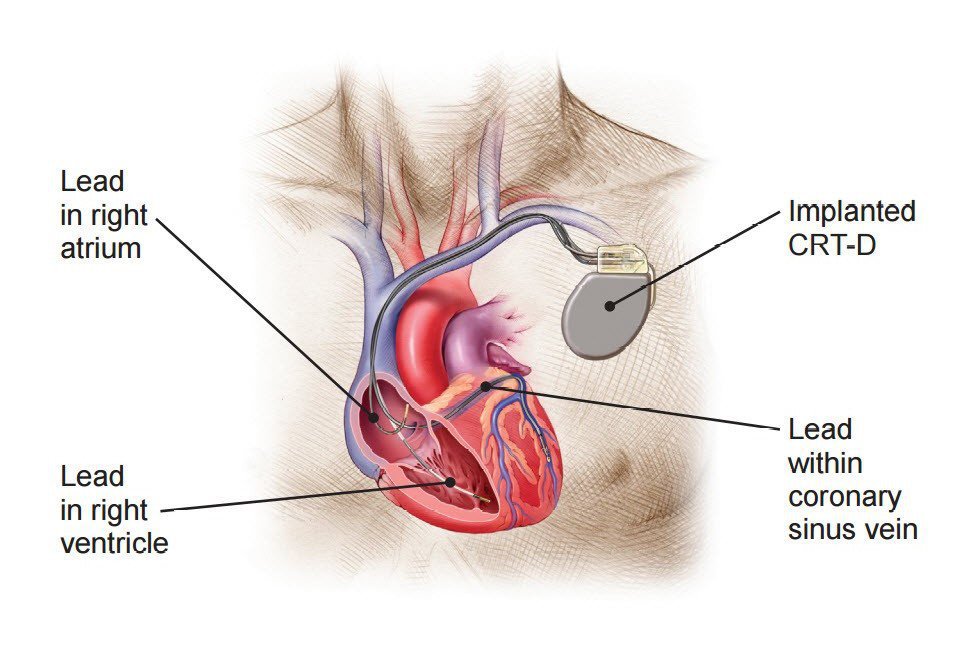 Cardiac Resynchronization