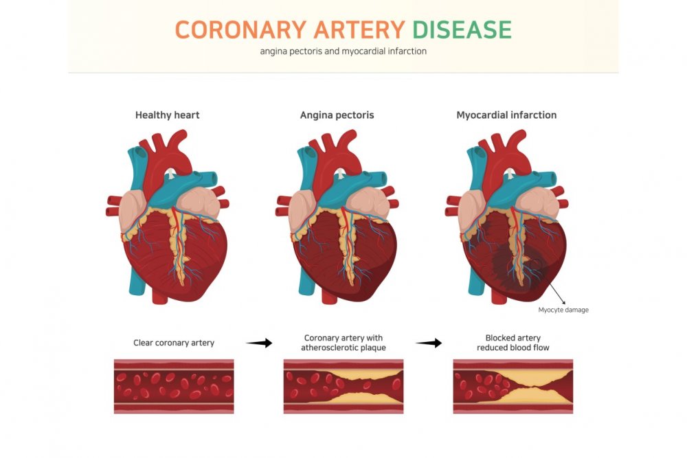 Coronary Artery Disease