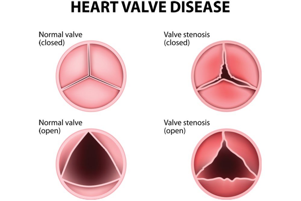 Heart Valve Disease