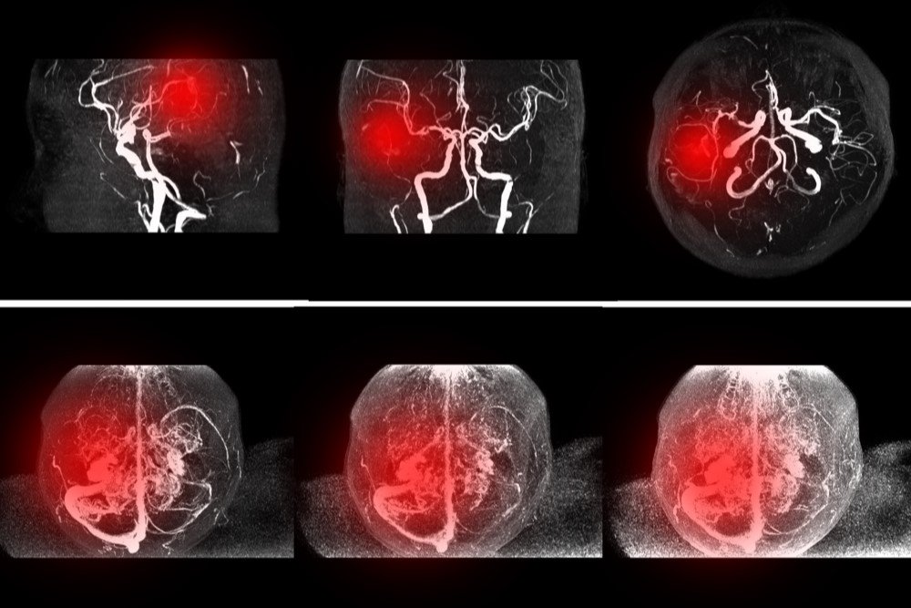 Subclavian Angiography