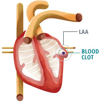 Atrial Fibrillation