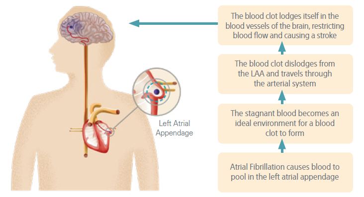 Risk of Stroke